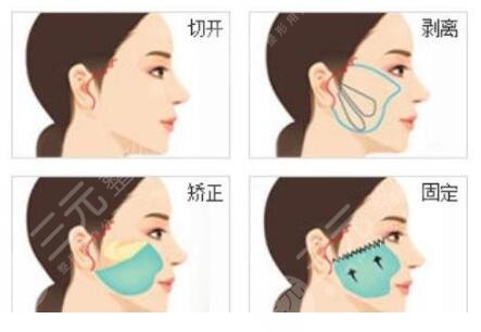 面部拉皮手術(shù)有風(fēng)險嗎