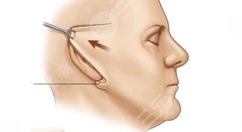 面部拉皮手術(shù)