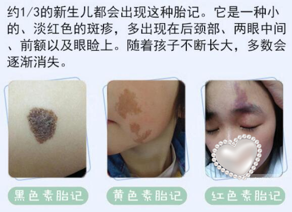 去胎記