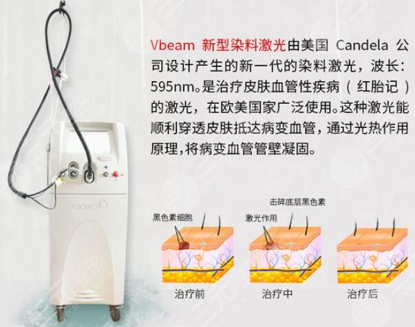 胎記激光能基本去除嗎