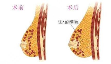 自體脂肪隆胸的適用人群