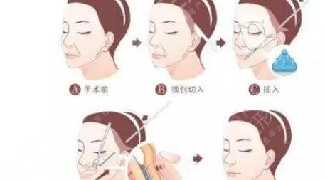 小切口拉皮手術(shù)