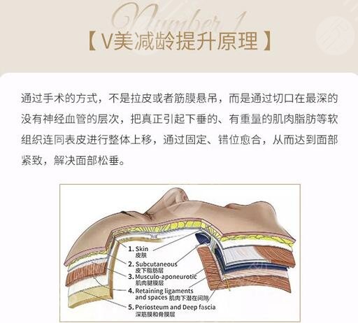 v美減齡真的那么好嗎，是什么手術(shù)？原理&價格分析，抗衰不踩雷！