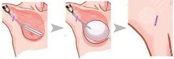 傲諾拉隆胸可以管多少年