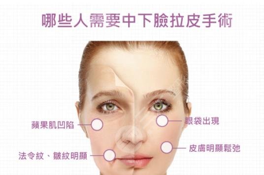 上海九院拉皮手術(shù)科普