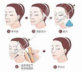 拉皮手術(shù)能維持幾年?多少錢?“恢復(fù)期_適合年齡”術(shù)前要了解哦~