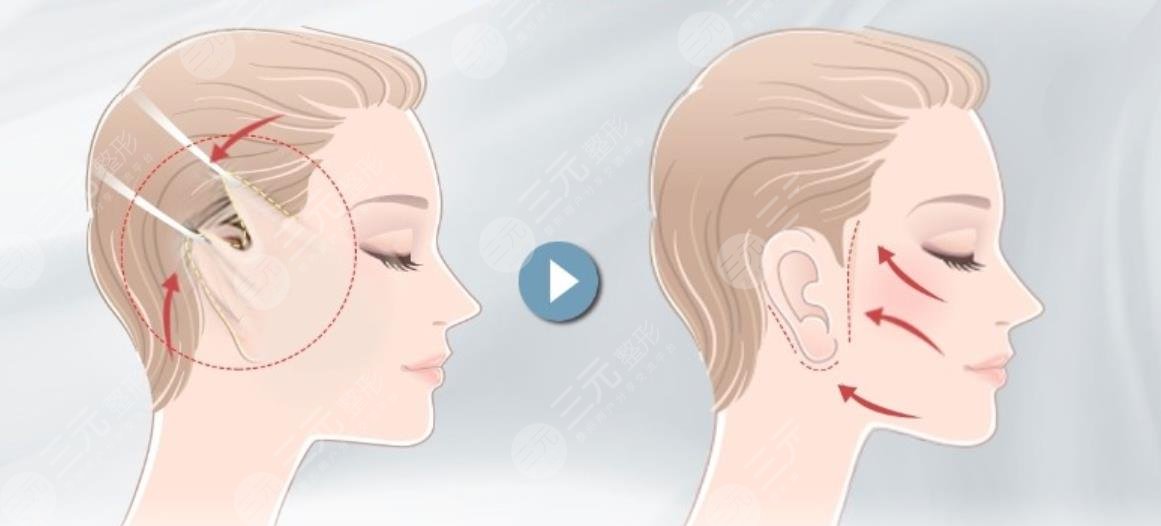 小拉皮手術(shù)過程