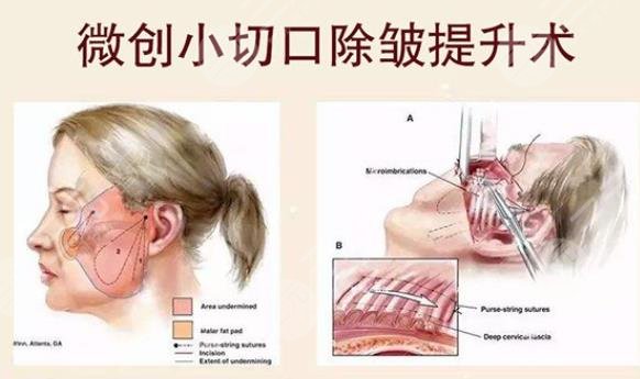 迷你小拉皮是什么原理