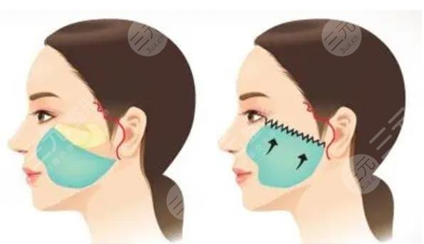 迷你小拉皮是什么原理