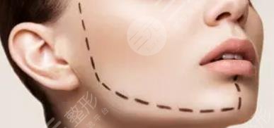 做拉皮手術(shù)的注意事項(xiàng)