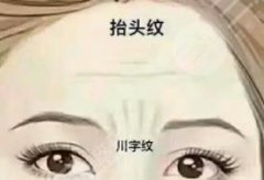 川字紋用什么填充果好？材料科普&注意事項(xiàng)講解，祛皺不用愁！