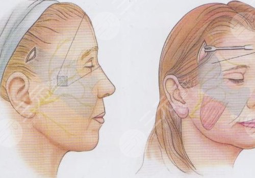 拉皮除皺手術(shù)收費價格