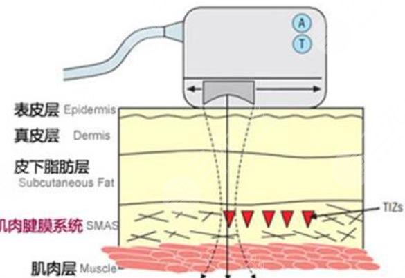 熱提拉的功與副作用