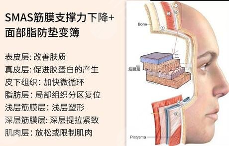 小切口拉皮術(shù)