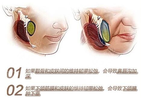 內(nèi)窺鏡除皺術(shù)缺點(diǎn)科普！手術(shù)果到底咋樣？一文解答你的困惑，附價(jià)格~
