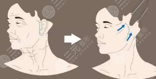 內(nèi)窺鏡拉皮手術是什么原理