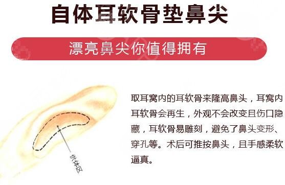 鼻尖縮小手術(shù)原理
