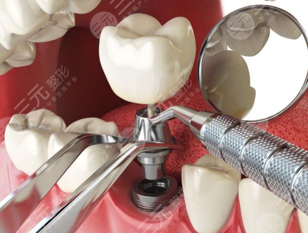 北京種植牙多少錢(qián)一顆2021