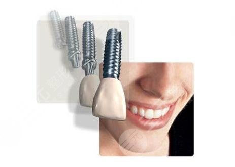 影響種植牙的價(jià)格有哪些?