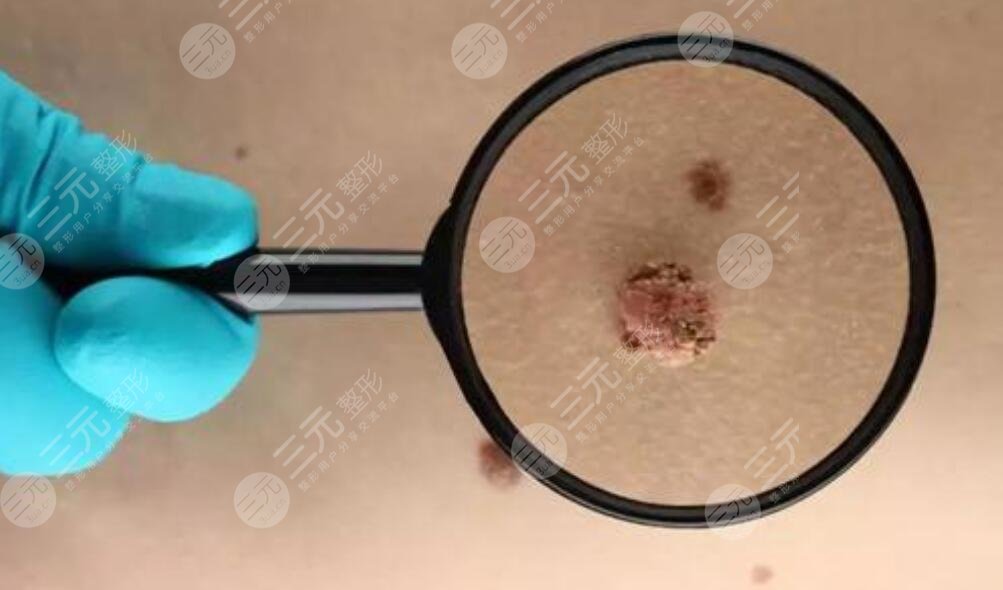 手術(shù)去痣的優(yōu)勢(shì)是什么