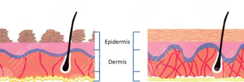 5d膠原光做一次多少錢