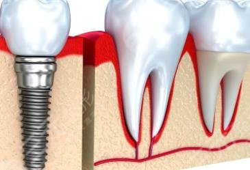 種植牙