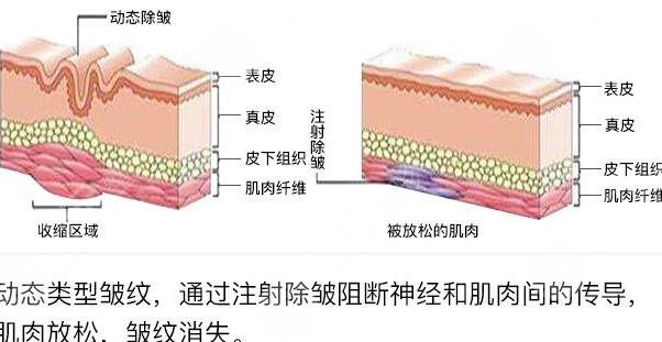 生物注射桿菌除皺