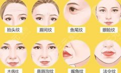 B****除皺多久能發(fā)揮作用，能維持多久？科普帶你正確認(rèn)識(shí)ta！附價(jià)格~