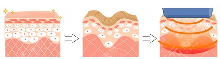 3D射頻美容手術(shù)的操作原理