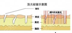 點陣激光除皺成好嗎？激光除皺的優(yōu)勢|注射和激光哪個更好？