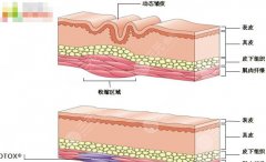 玻尿酸除皺可以維持多長時(shí)間？3大原因影響了維持時(shí)間，是哪三點(diǎn)呢？
