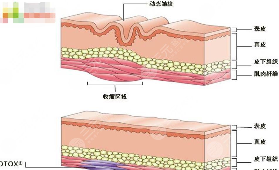 玻尿酸除皺可以維持多長時間？3大原因影響了維持時間，是哪三點呢？
