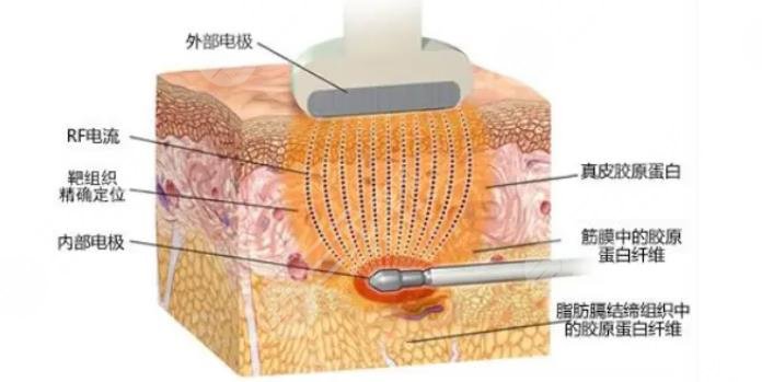 3d射頻緊膚去皺項目表202