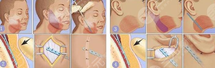 內(nèi)窺鏡拉皮和普通拉皮區(qū)別在哪些地方?