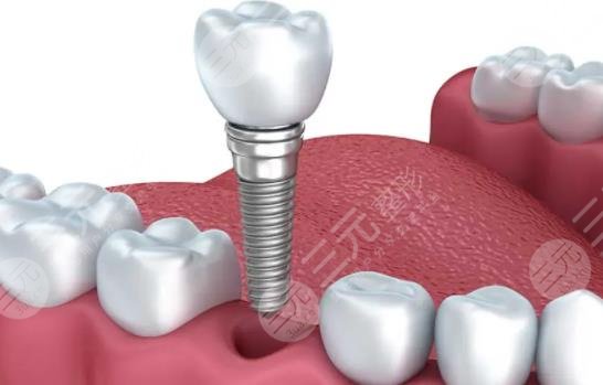種植牙