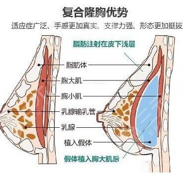 什么是復(fù)合隆胸