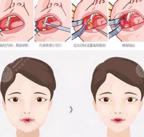 頰脂墊和面部吸脂有什么區(qū)別