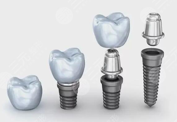 種植牙的果顯著嗎