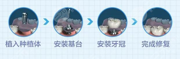 種植牙一般要多長時間