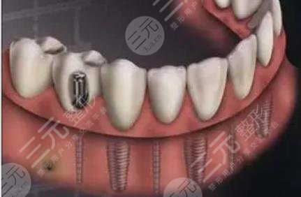 種植牙