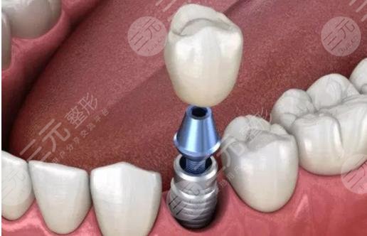 種植牙