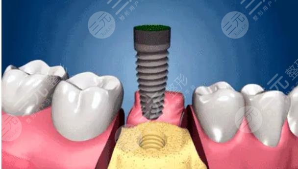 種植牙