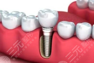 種植牙