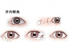 開眼角和不開的區(qū)別圖對比來襲，哪個(gè)好看你來品！科普手術(shù)知識！