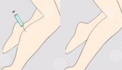 注射瘦腿的副作用科普！醫(yī)美別光看果，注意事項不能忘！