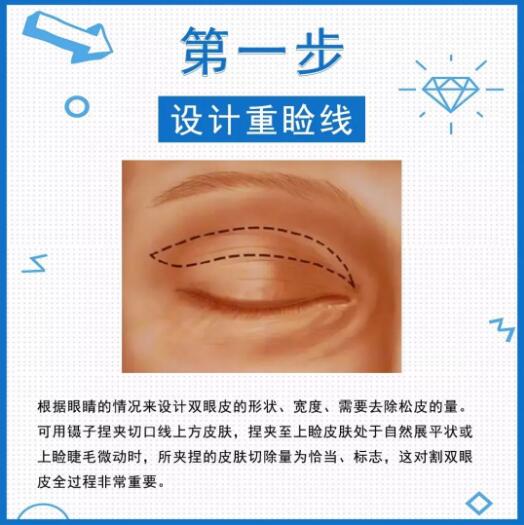 切雙眼皮全過程圖文科普來咯！6步造就電力媚眼，你細品！