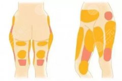 怎么抽脂肪做手術(shù)圖片科普！纖體塑形的原理揭秘，戳我get新知識(shí)！