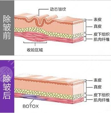 B****除皺后都有什么注意事項(xiàng)