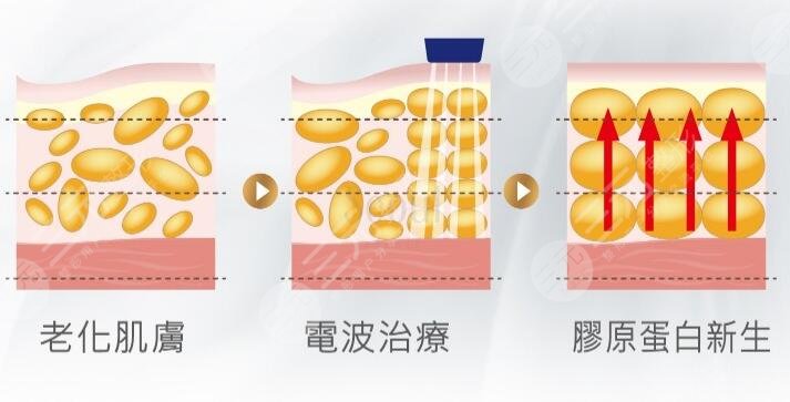 激光除皺手術(shù)之后需要注意什么呢