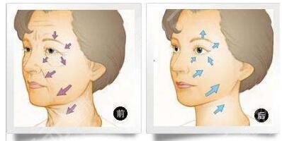 臉部干瘦的愛美者做完激光除皺手術(shù)